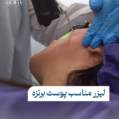 دستگاه موتوس (Motus AX) برای لیزر موهای زائد در رشت